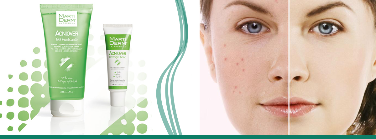 produse de îngrijire a pielii pentru acnee împotriva îmbătrânirii)